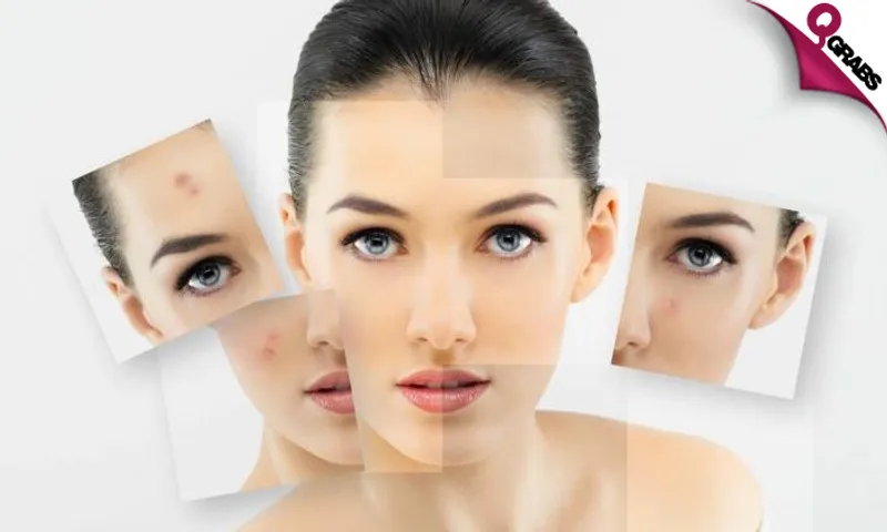 Acne Treatment & Care Online Course!